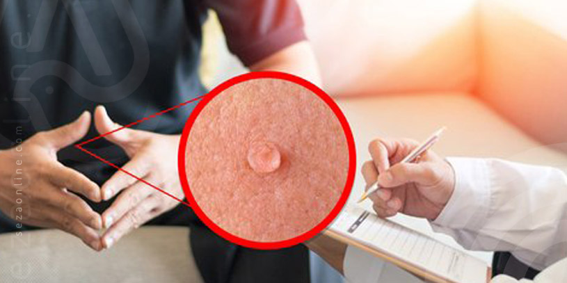 حکم دادگاه برای زگیل تناسلی حکم دادگاه برای زگیل تناسلی